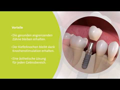 Youtube: Implantatgetragene Lösungen bei Zahnlücken